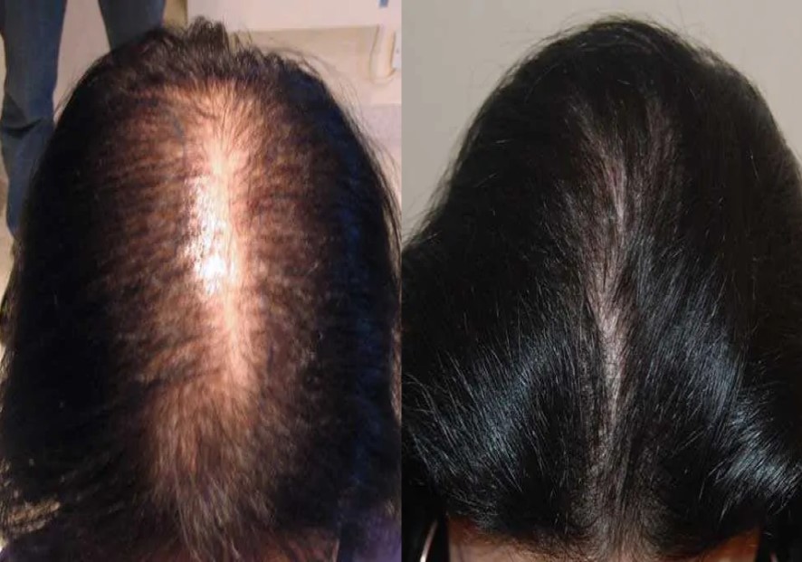 FUT-Women-1500-Graft-Hair-Transplant