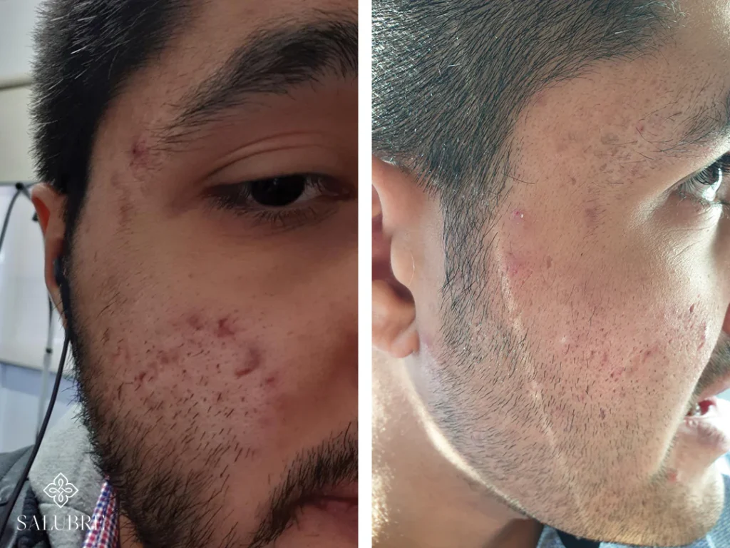acne-before-and-after-salubre