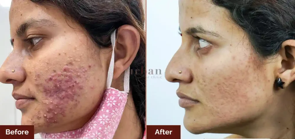 pranjali-shitole-acne-after-before-result-1024x485